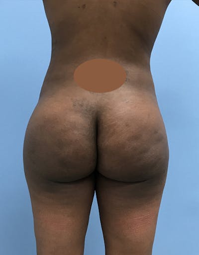 Brazilian Butt Lift Before & After Gallery - Patient 120905028 - Image 2