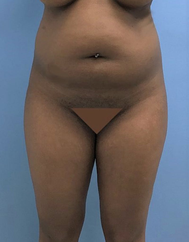 Brazilian Butt Lift Before & After Gallery - Patient 120905028 - Image 3