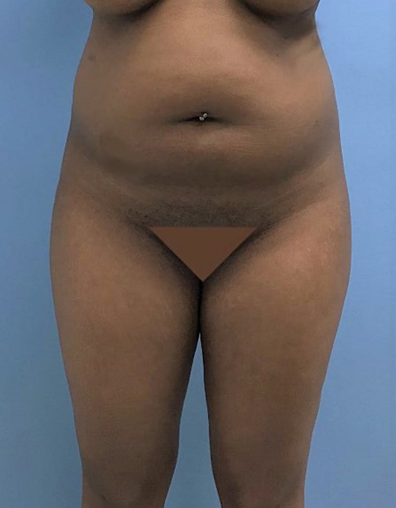 Brazilian Butt Lift Gallery - Patient 120905028 - Image 3