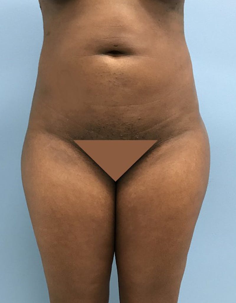 Brazilian Butt Lift Before & After Gallery - Patient 120905028 - Image 4