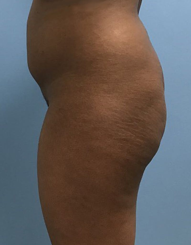 Brazilian Butt Lift Before & After Gallery - Patient 120905028 - Image 5