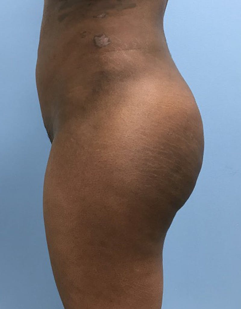 Brazilian Butt Lift Before & After Gallery - Patient 120905028 - Image 6