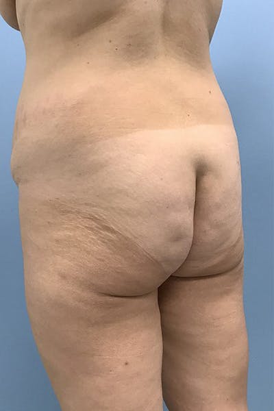 Brazilian Butt Lift Before & After Gallery - Patient 120905031 - Image 1