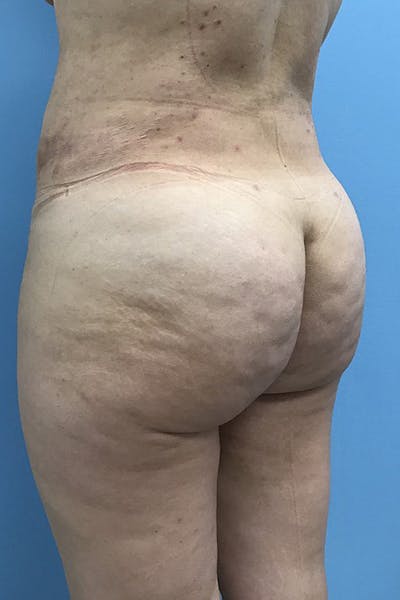 Brazilian Butt Lift Before & After Gallery - Patient 120905031 - Image 2