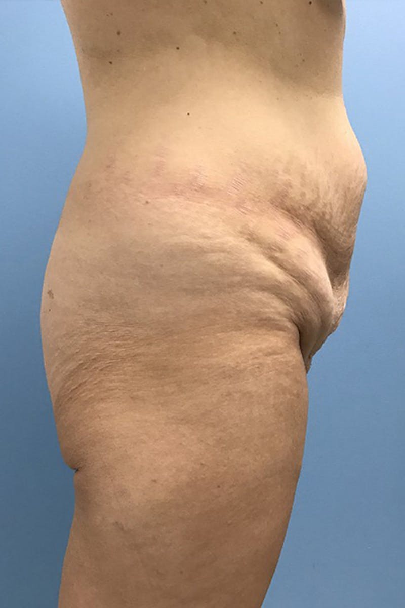 Brazilian Butt Lift Before & After Gallery - Patient 120905031 - Image 3