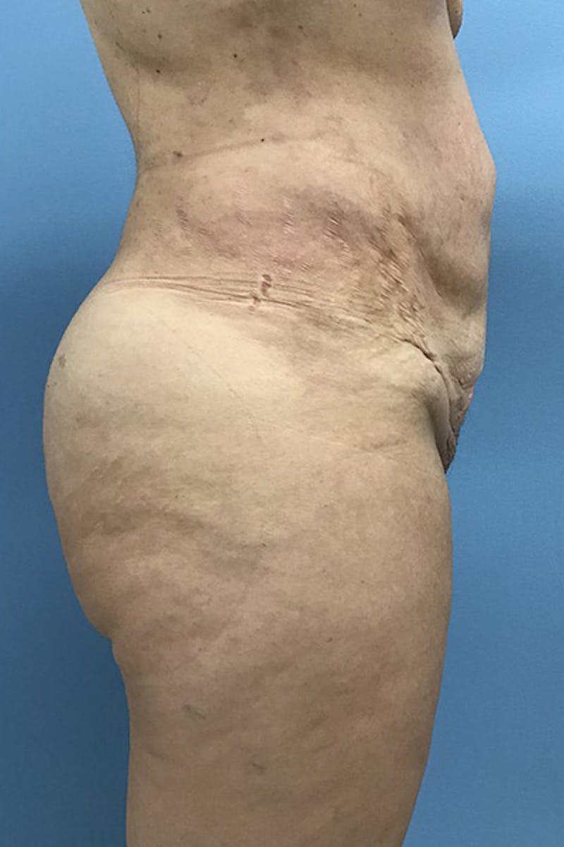 Brazilian Butt Lift Before & After Gallery - Patient 120905031 - Image 4