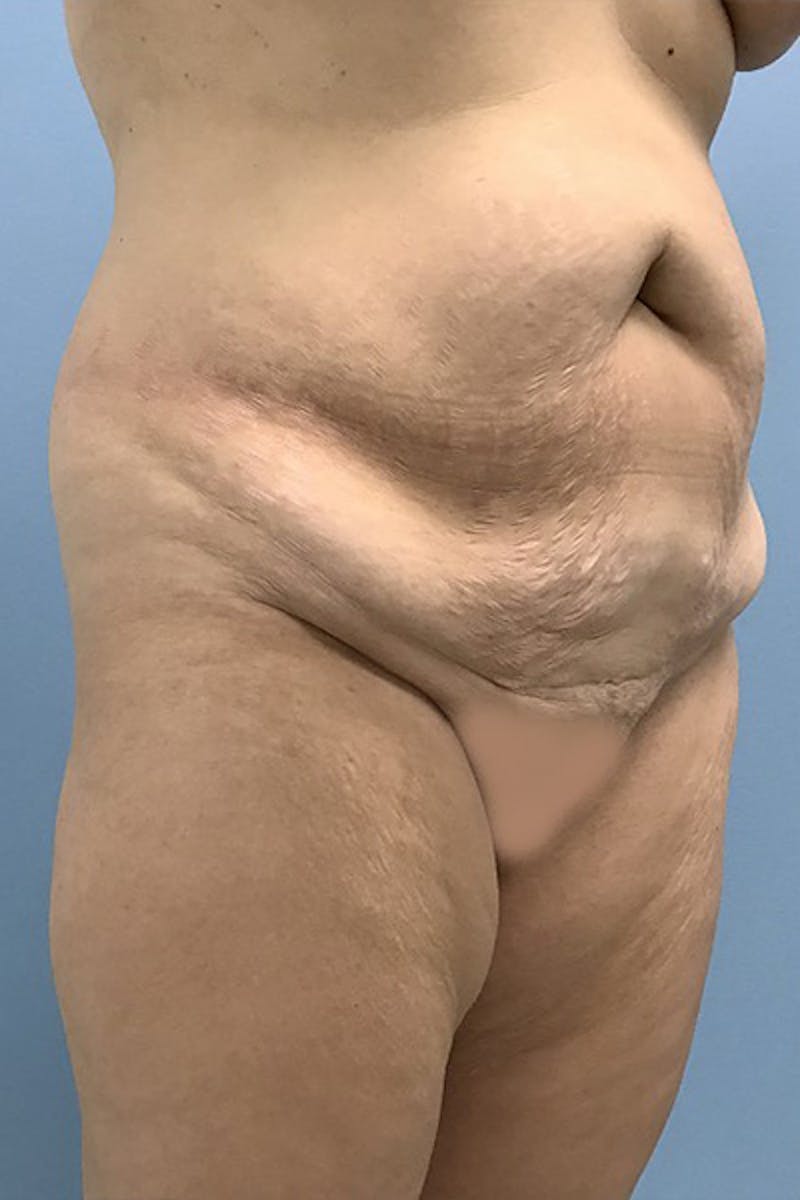 Brazilian Butt Lift Before & After Gallery - Patient 120905031 - Image 5