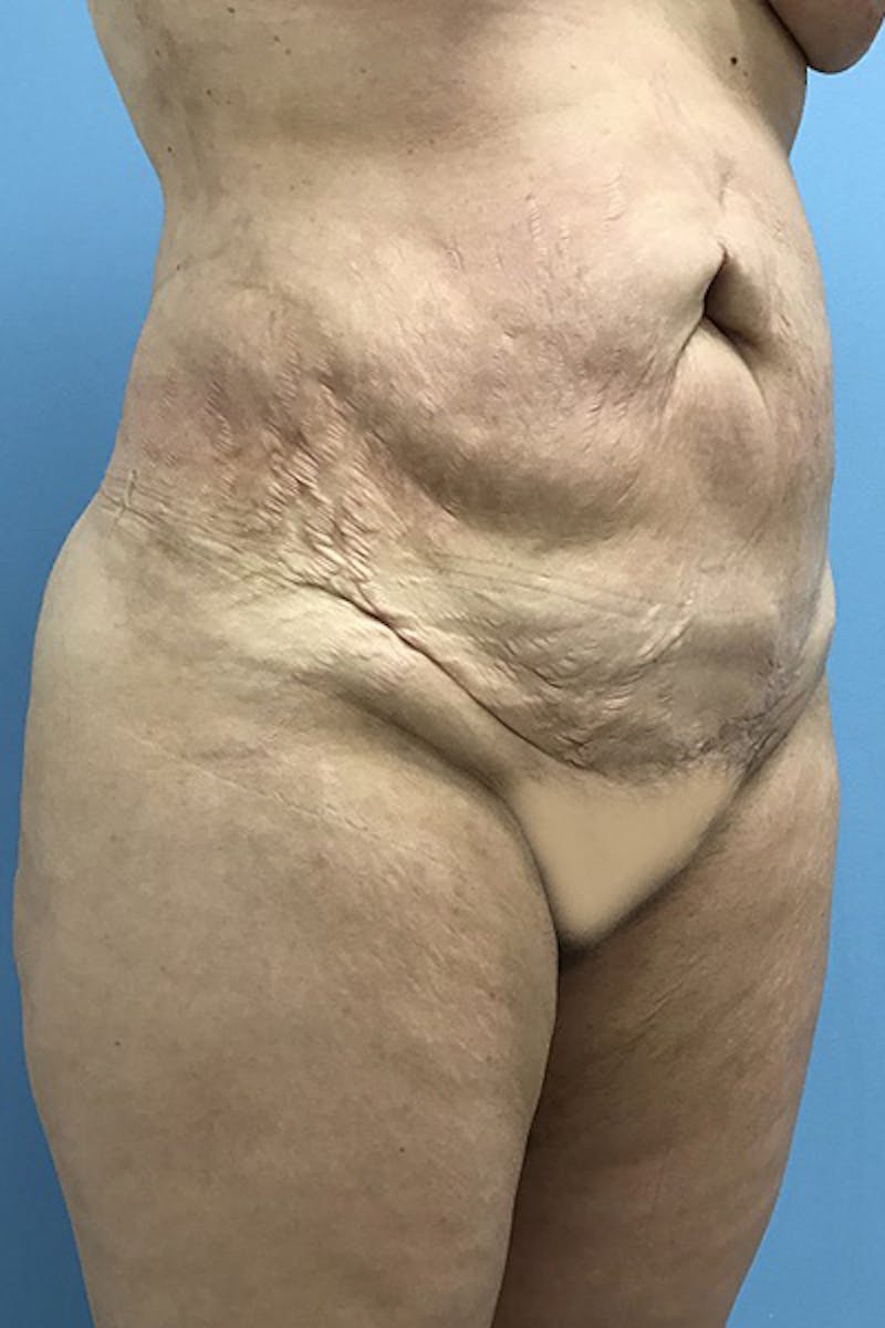 Brazilian Butt Lift Before & After Gallery - Patient 120905031 - Image 6