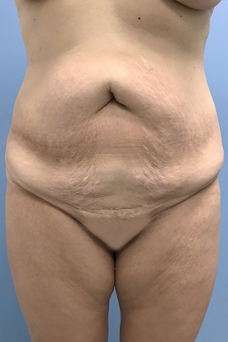 Brazilian Butt Lift Before & After Gallery - Patient 120905031 - Image 7