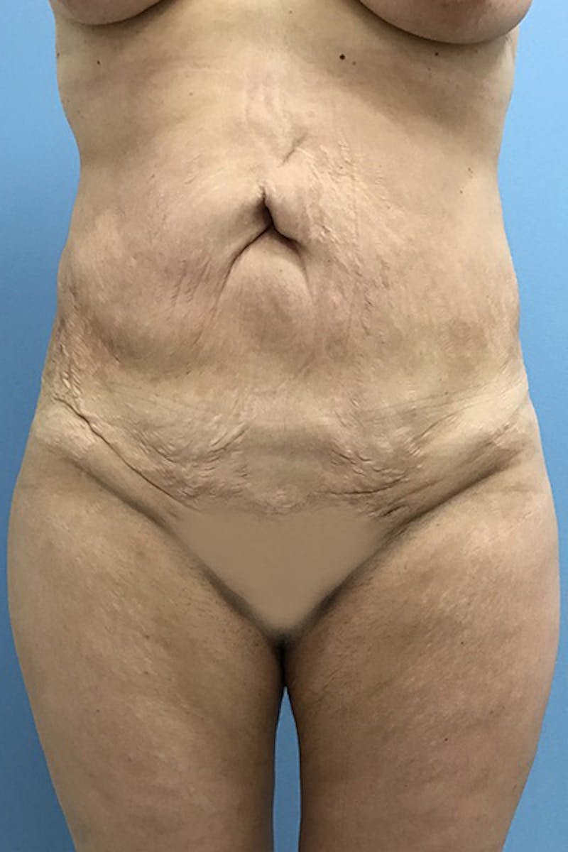 Brazilian Butt Lift Gallery - Patient 120905031 - Image 8