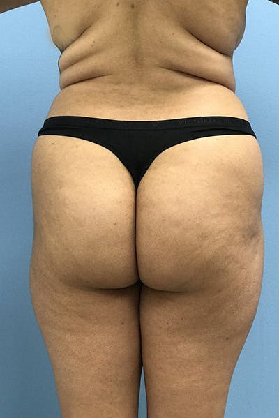 Brazilian Butt Lift Before & After Gallery - Patient 120905032 - Image 1