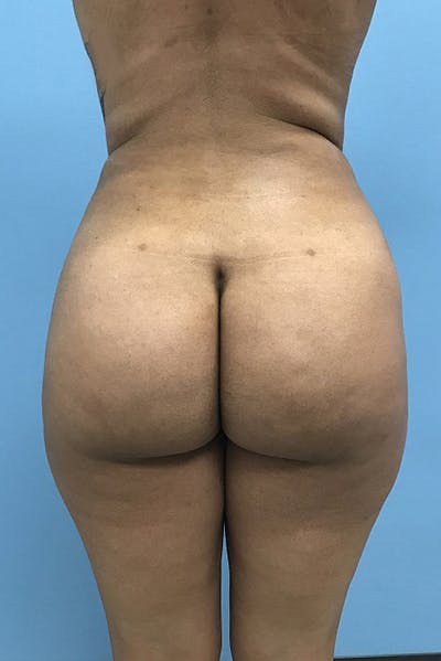 Brazilian Butt Lift Before & After Gallery - Patient 120905032 - Image 2
