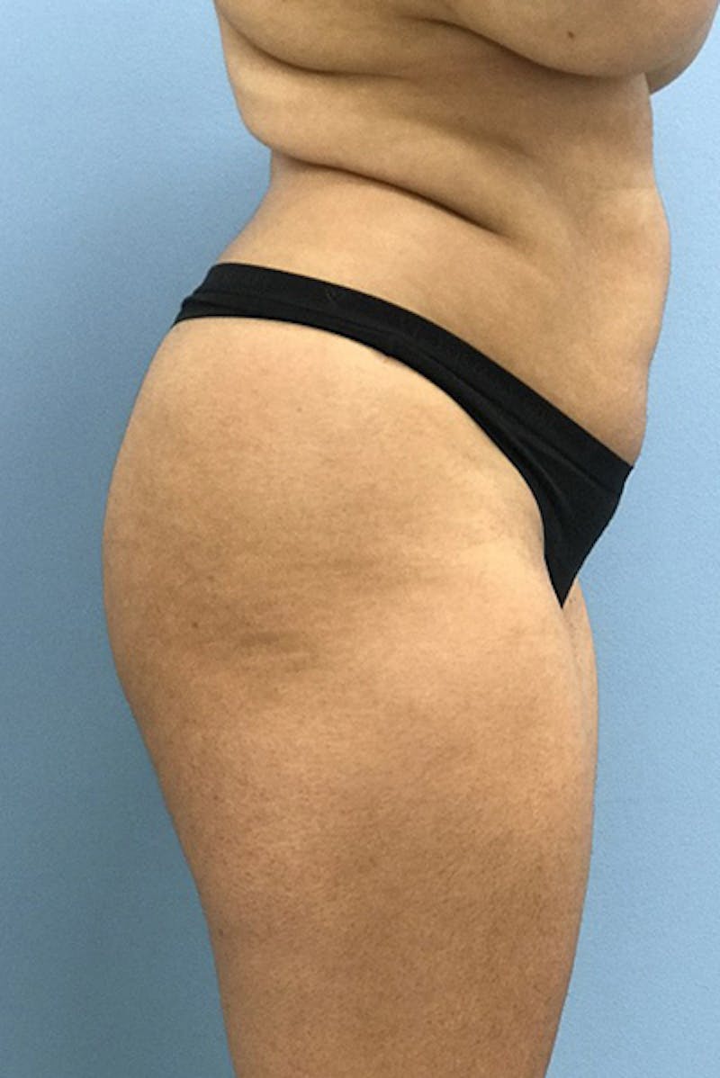 Brazilian Butt Lift Before & After Gallery - Patient 120905032 - Image 3