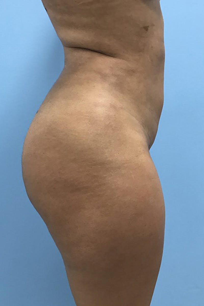 Brazilian Butt Lift Before & After Gallery - Patient 120905032 - Image 4
