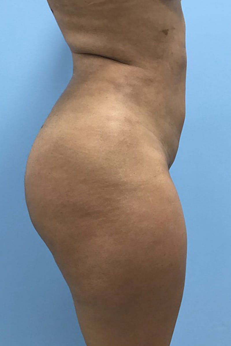 Brazilian Butt Lift Gallery - Patient 120905032 - Image 4