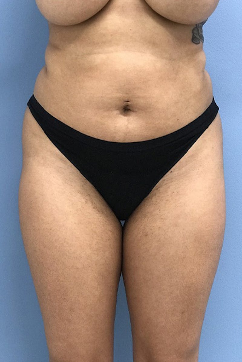 Brazilian Butt Lift Before & After Gallery - Patient 120905032 - Image 5