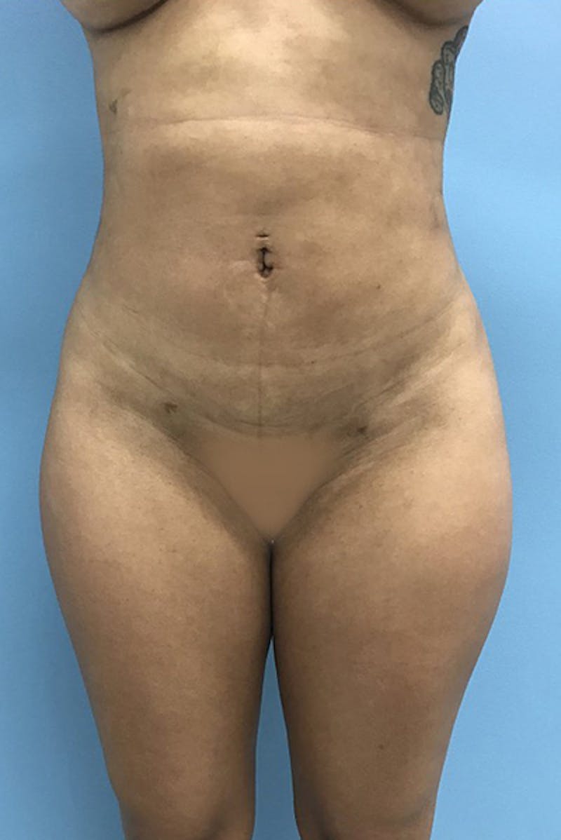 Brazilian Butt Lift Before & After Gallery - Patient 120905032 - Image 6