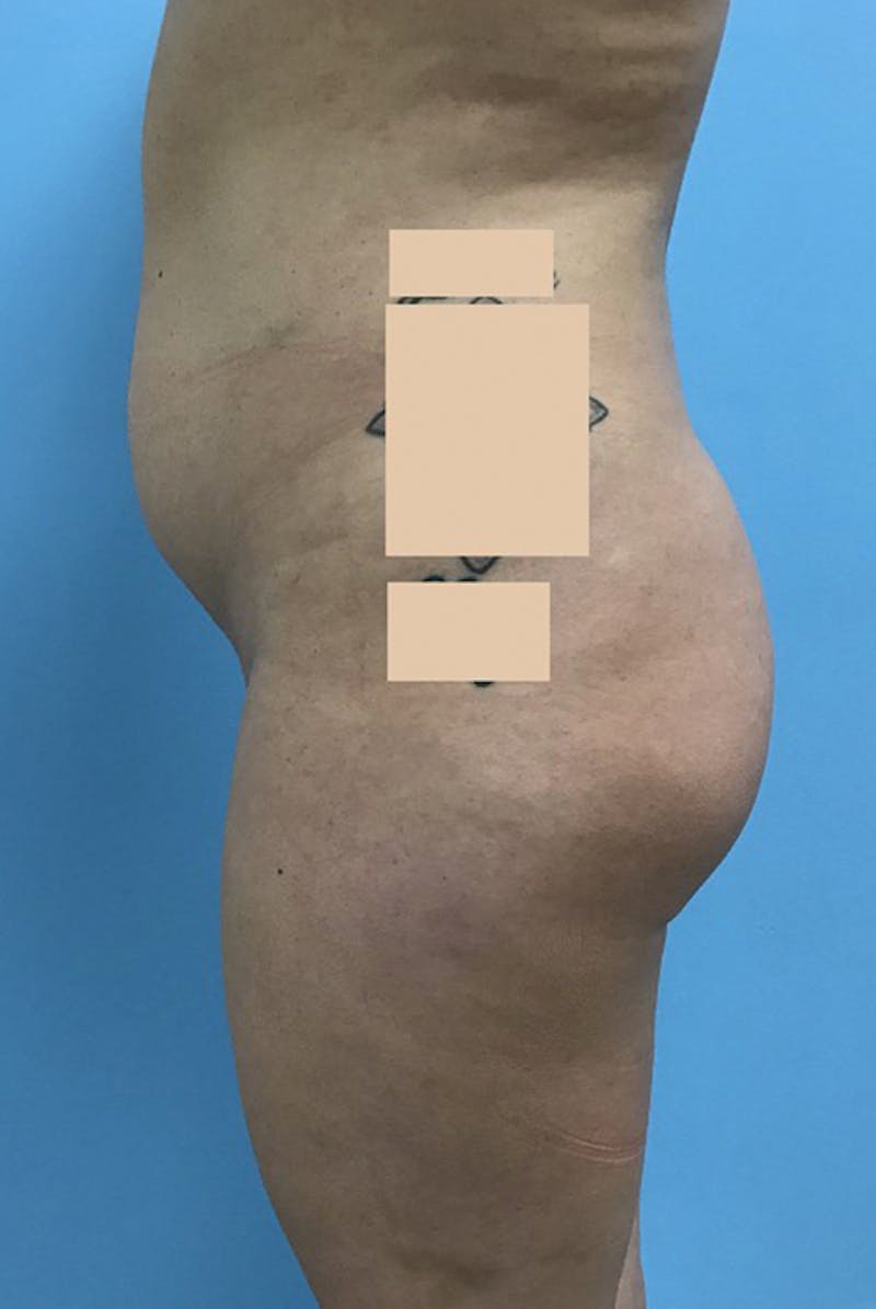 Brazilian Butt Lift Before & After Gallery - Patient 120905042 - Image 3