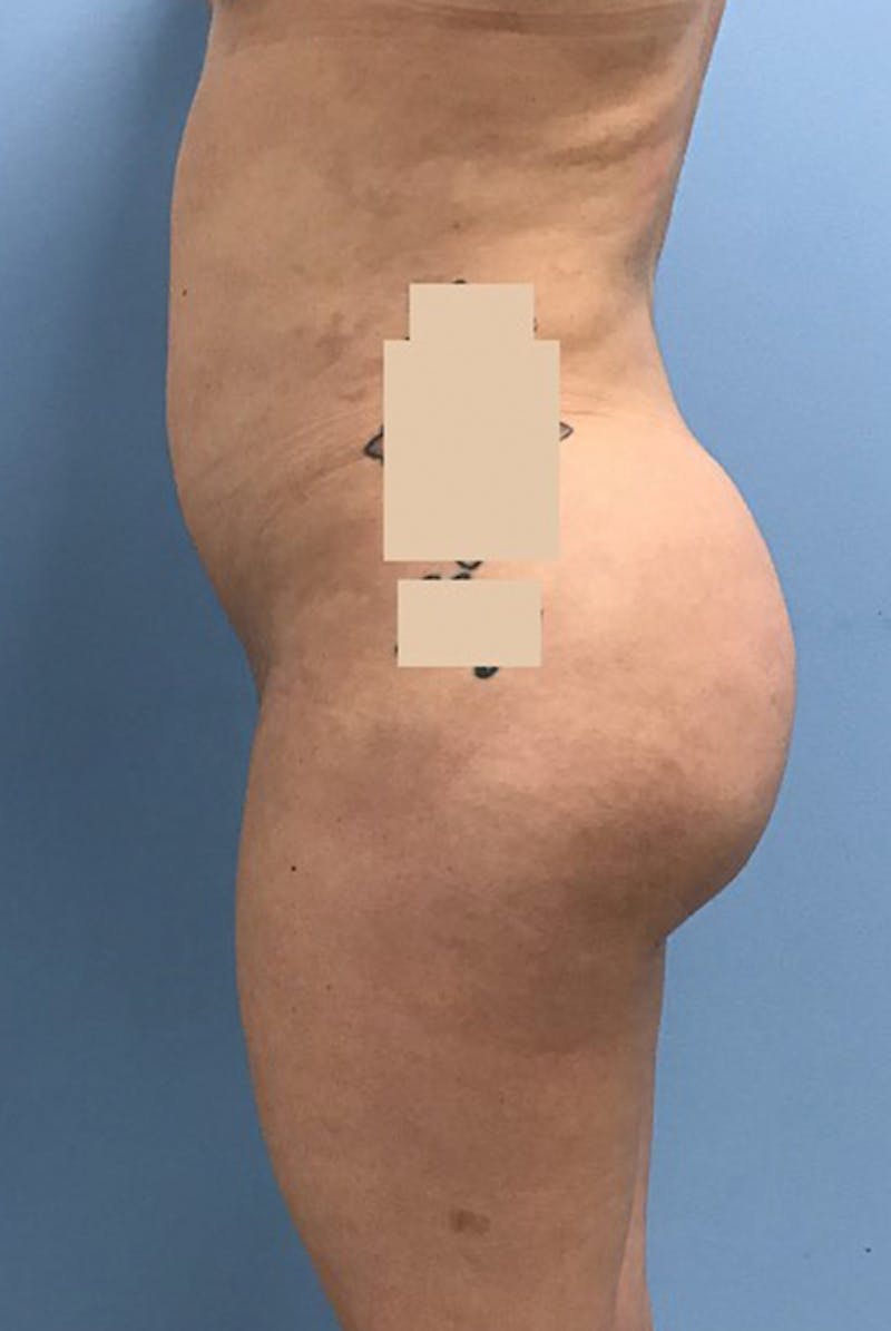 Brazilian Butt Lift Before & After Gallery - Patient 120905042 - Image 4