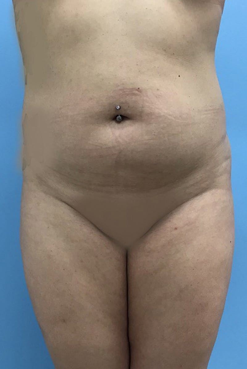 Brazilian Butt Lift Before & After Gallery - Patient 120905042 - Image 5