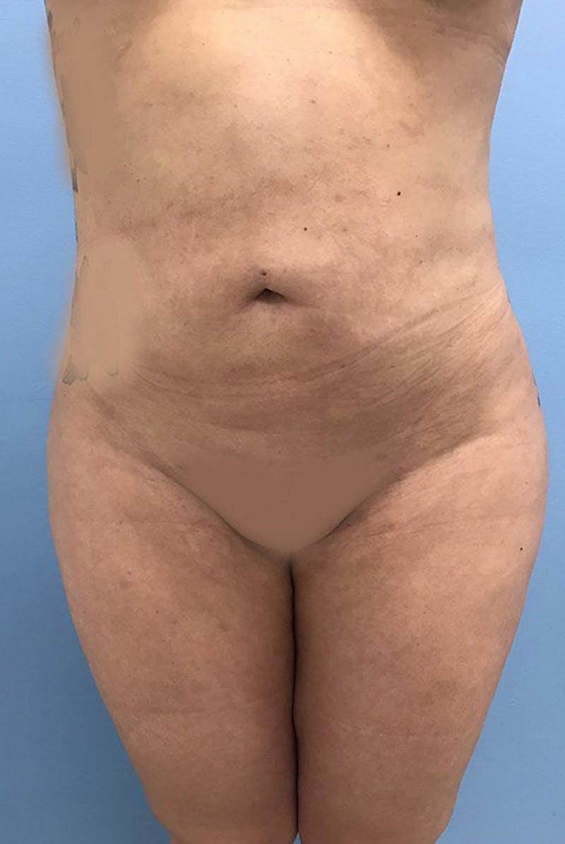 Brazilian Butt Lift Before & After Gallery - Patient 120905042 - Image 6