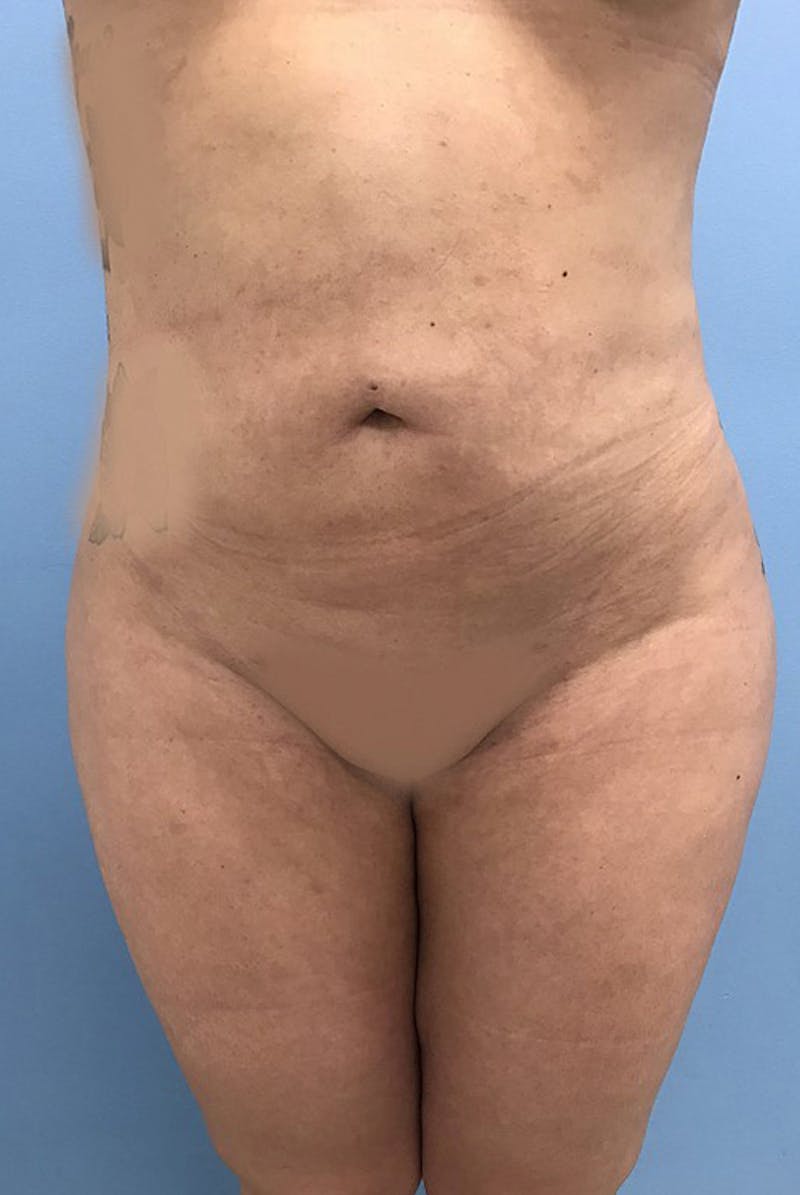 Brazilian Butt Lift Gallery - Patient 120905042 - Image 6