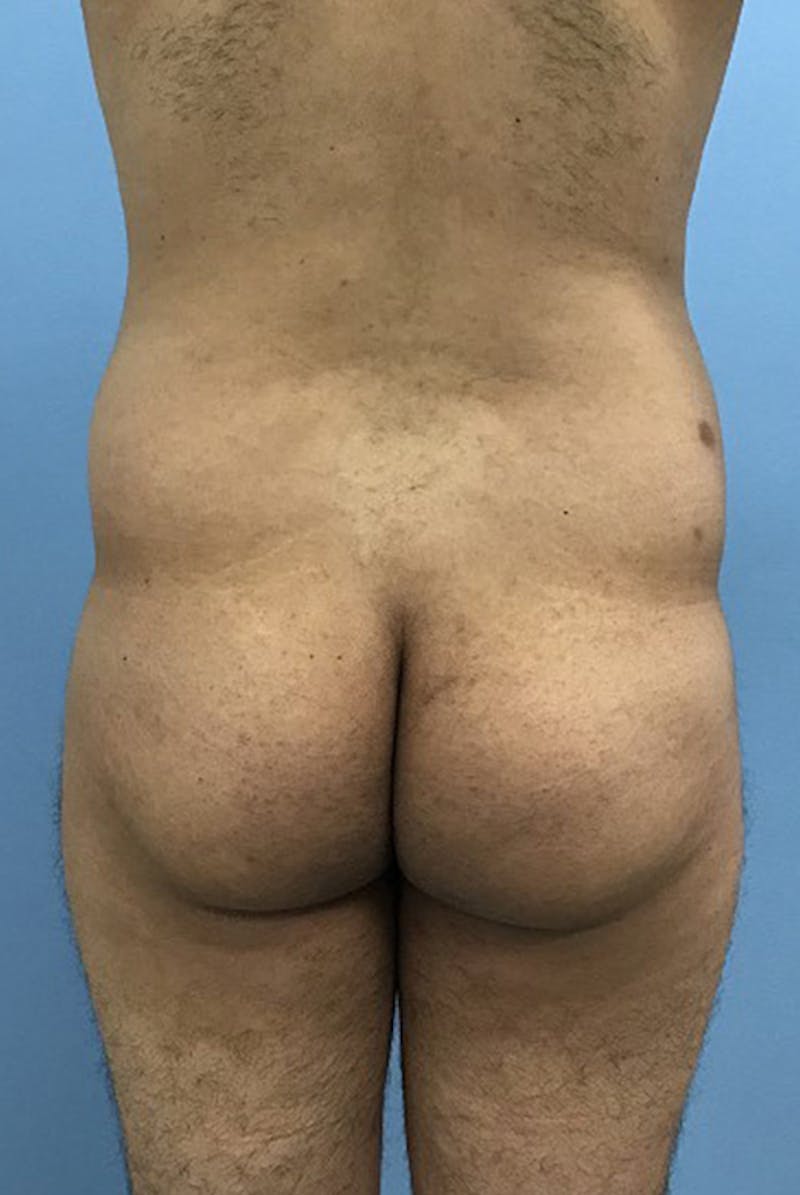 Brazilian Butt Lift Before & After Gallery - Patient 120905044 - Image 1