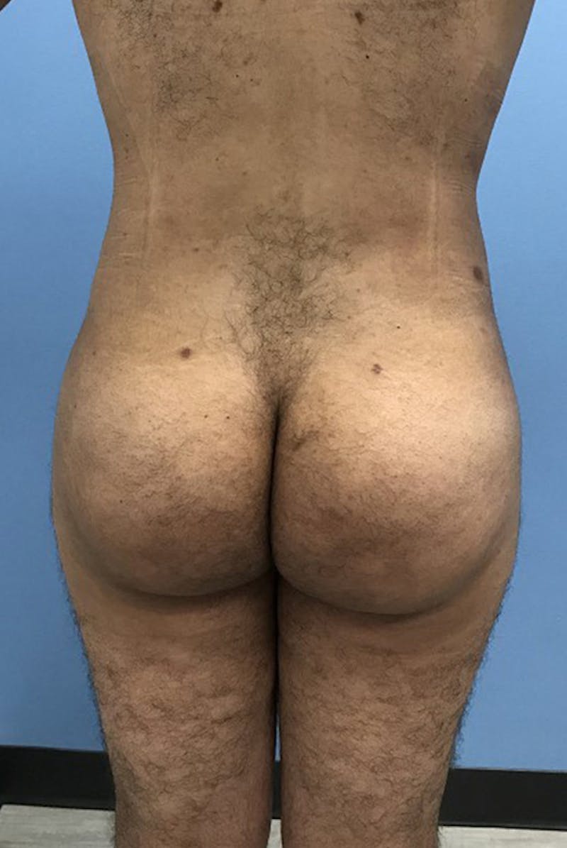 Brazilian Butt Lift Before & After Gallery - Patient 120905044 - Image 2
