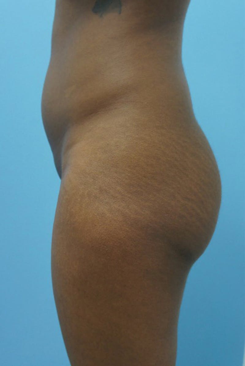Brazilian Butt Lift Before & After Gallery - Patient 120905046 - Image 3
