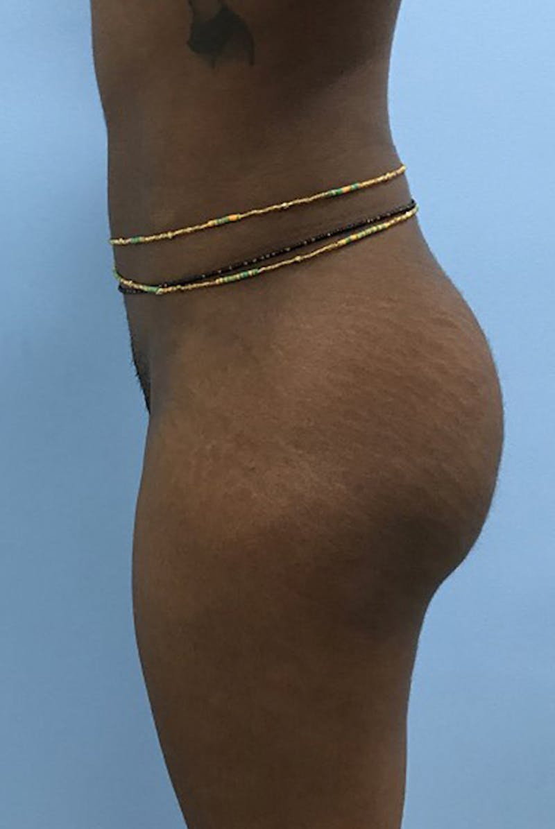 Brazilian Butt Lift Before & After Gallery - Patient 120905046 - Image 4