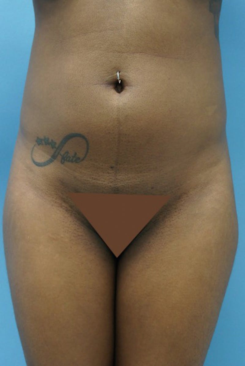 Brazilian Butt Lift Gallery - Patient 120905046 - Image 5