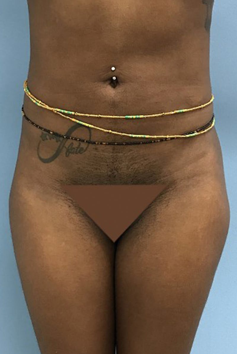 Brazilian Butt Lift Before & After Gallery - Patient 120905046 - Image 6
