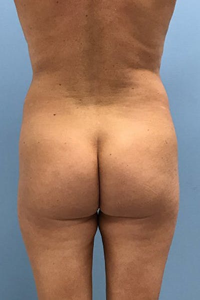 Brazilian Butt Lift Before & After Gallery - Patient 120905049 - Image 1