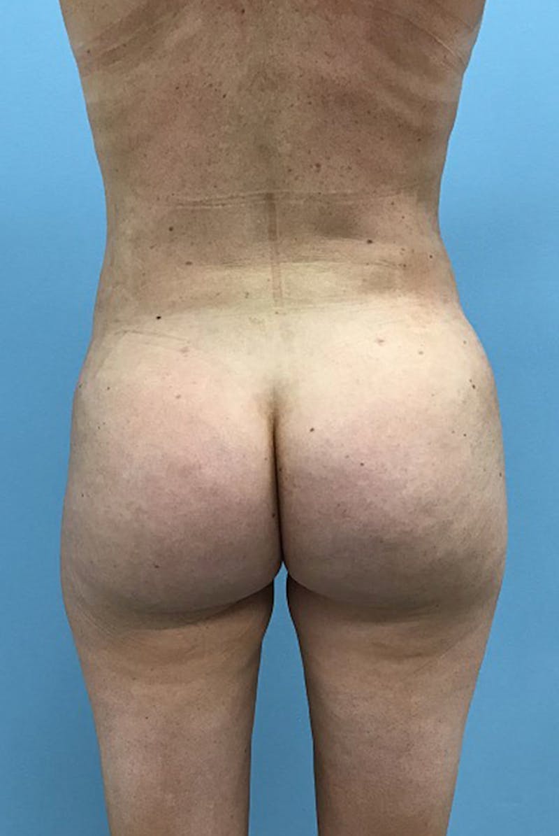 Brazilian Butt Lift Before & After Gallery - Patient 120905049 - Image 2