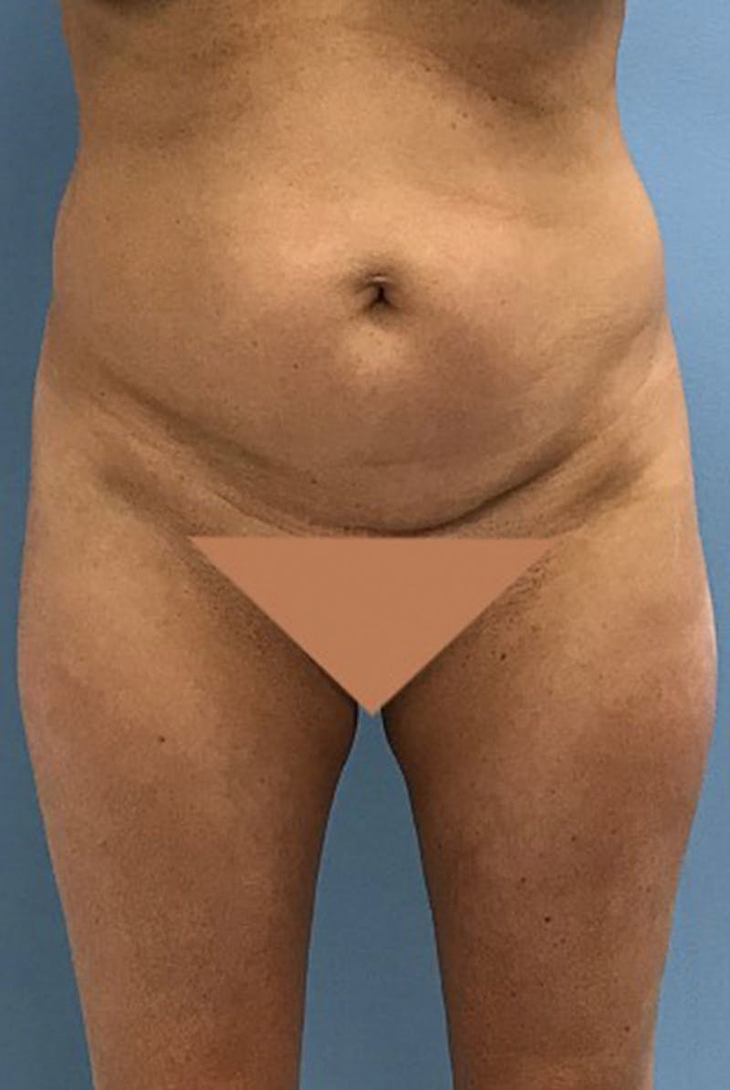Brazilian Butt Lift Before & After Gallery - Patient 120905049 - Image 5