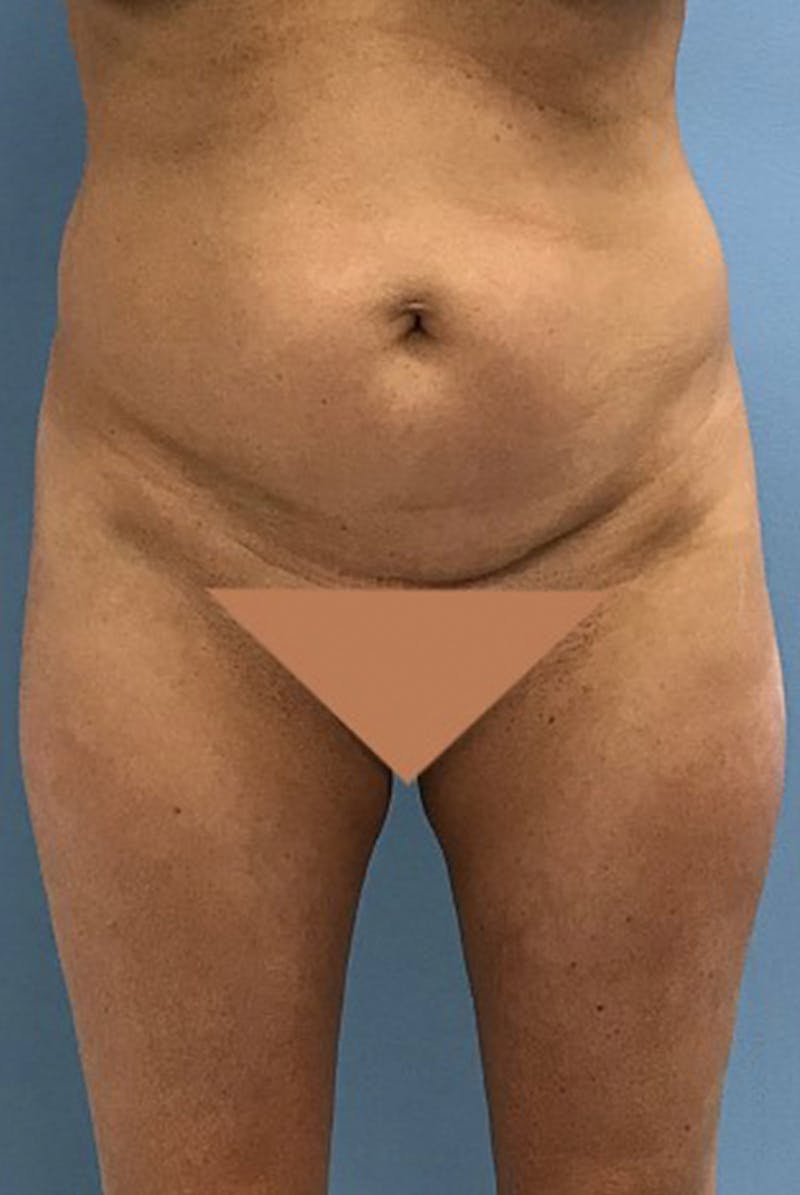 Brazilian Butt Lift Gallery - Patient 120905049 - Image 5