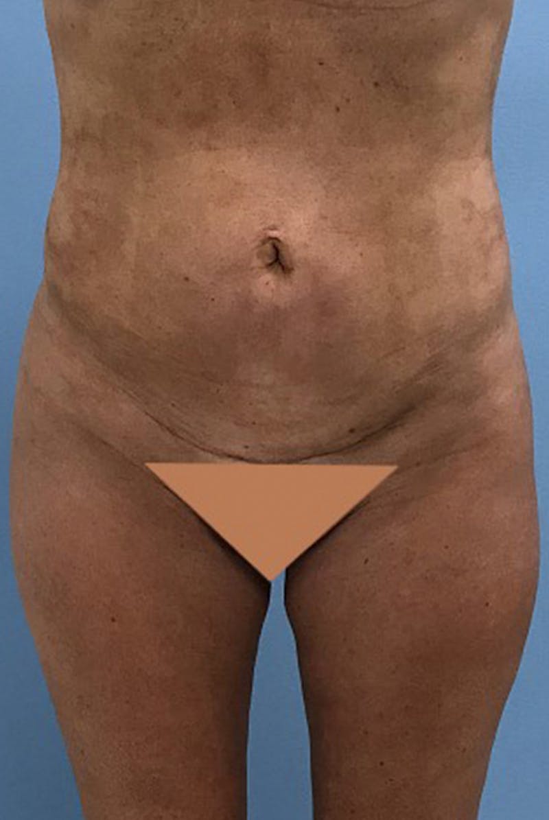 Brazilian Butt Lift Before & After Gallery - Patient 120905049 - Image 6