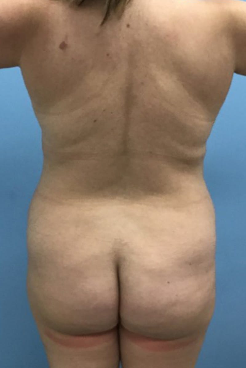 Brazilian Butt Lift Before & After Gallery - Patient 120905052 - Image 1