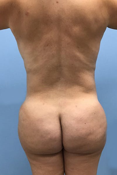 Brazilian Butt Lift Before & After Gallery - Patient 120905052 - Image 2