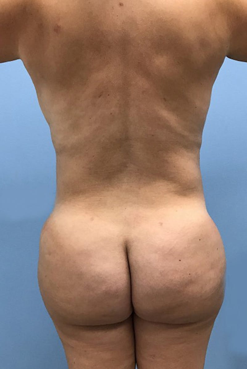 Brazilian Butt Lift Before & After Gallery - Patient 120905052 - Image 2