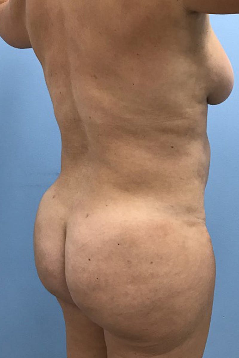 Brazilian Butt Lift Gallery - Patient 120905052 - Image 4