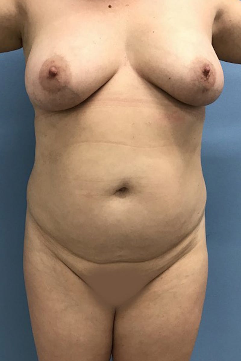 Brazilian Butt Lift Before & After Gallery - Patient 120905052 - Image 5