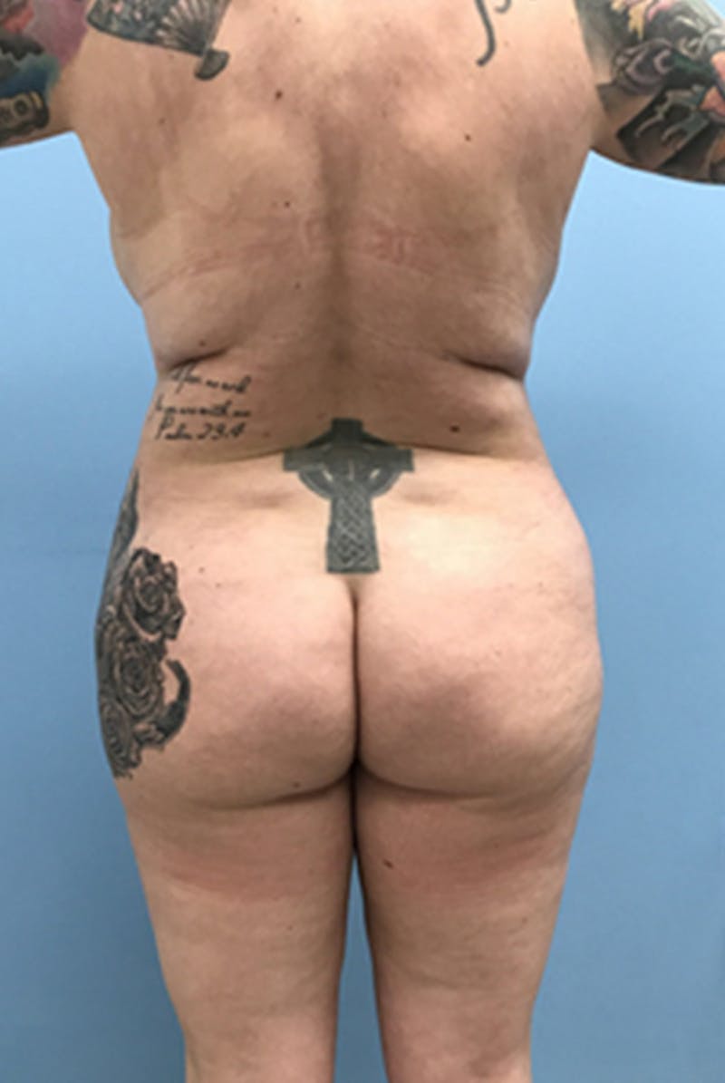 Brazilian Butt Lift Before & After Gallery - Patient 120905054 - Image 1