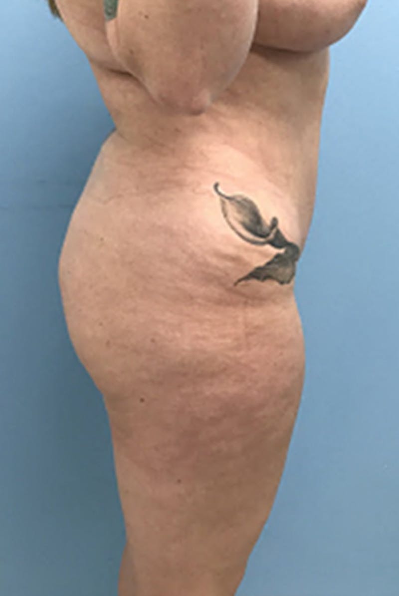 Brazilian Butt Lift Before & After Gallery - Patient 120905054 - Image 5
