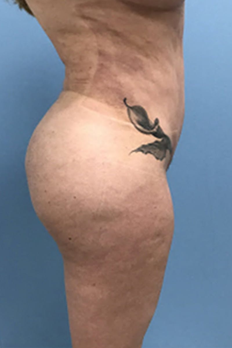 Brazilian Butt Lift Before & After Gallery - Patient 120905054 - Image 6