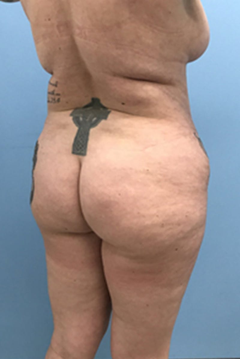 Brazilian Butt Lift Before & After Gallery - Patient 120905054 - Image 7