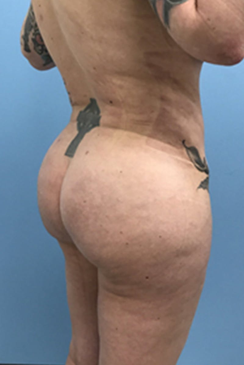 Brazilian Butt Lift Before & After Gallery - Patient 120905054 - Image 8