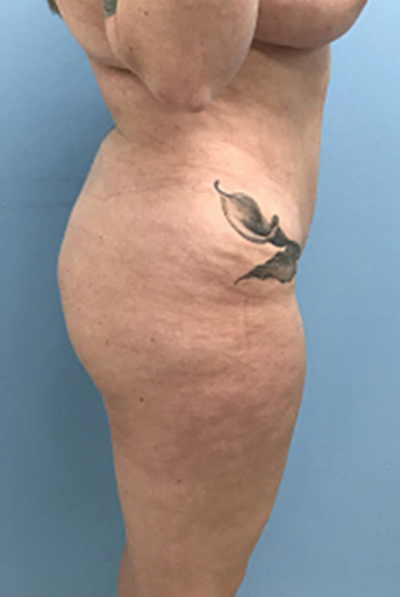 Brazilian Butt Lift Before & After Gallery - Patient 120905054 - Image 9