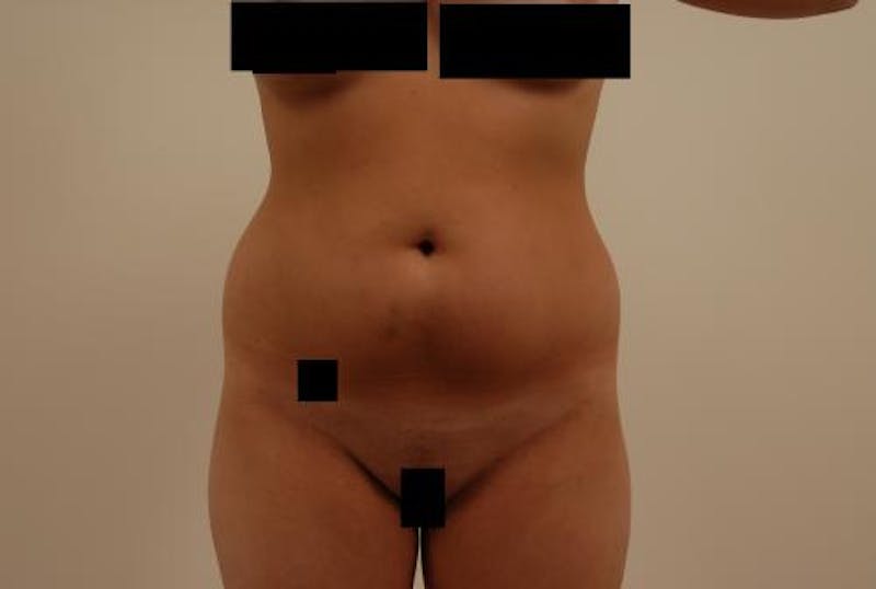 Liposuction Before & After Gallery - Patient 120905122 - Image 1