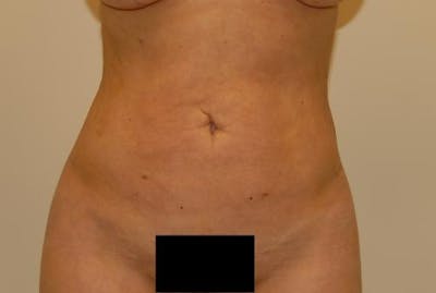Liposuction Gallery - Patient 120905123 - Image 2